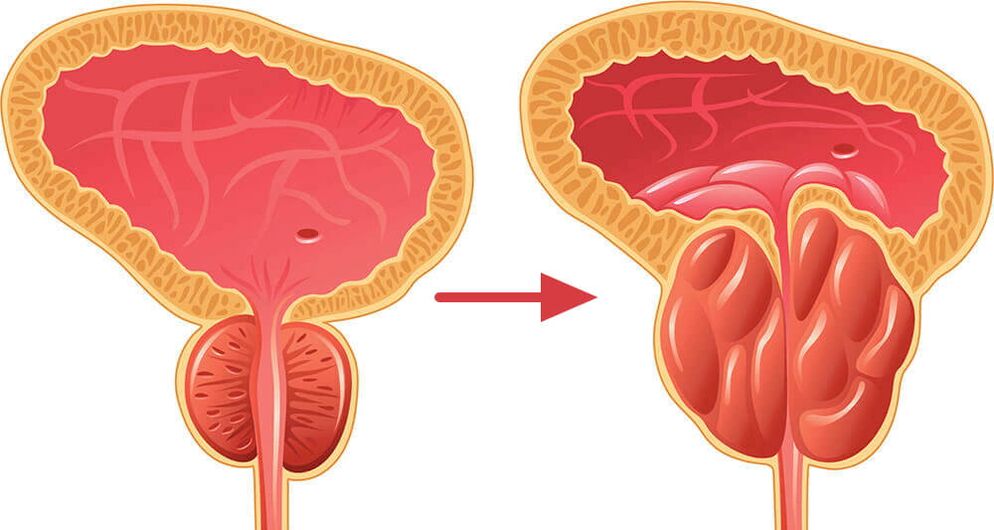 Glande de la prostate - normale et enflammée