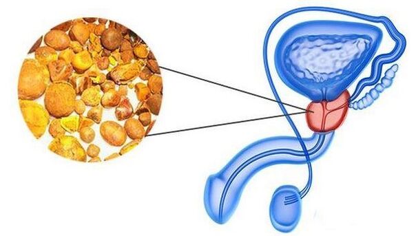 Calculer dans la glande de la prostate