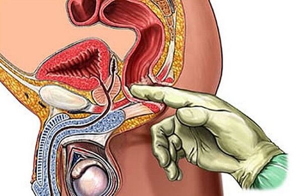 Le massage de la prostate comme méthode de traitement de la prostatite