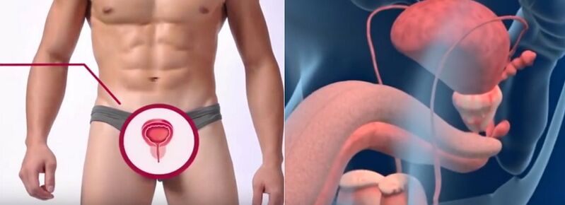Prostatite chez l'homme, reconnaissable à certains signes
