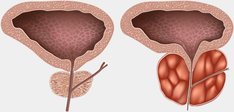 prostate saine et enflammée avec prostatite