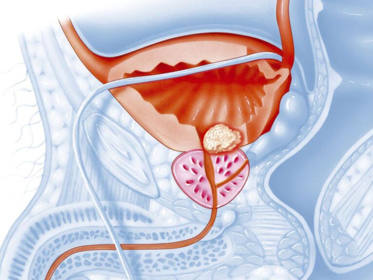 Dans la prostatite chronique, la lumière de l'urètre se rétrécit, ce qui rend difficile l'évacuation de l'urine. 