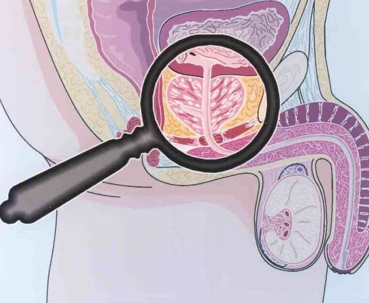 Défaite du tissu prostatique chez les patients atteints de prostatite chronique hommes