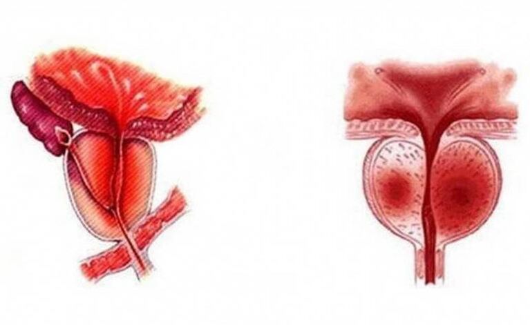 Inflammation aiguë de la prostate, qui peut devenir chronique